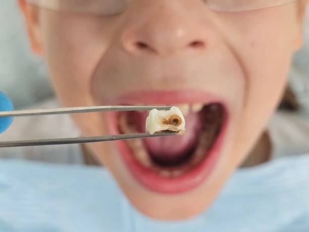 Best Emergency Wisdom Teeth Removal in Florence, MT