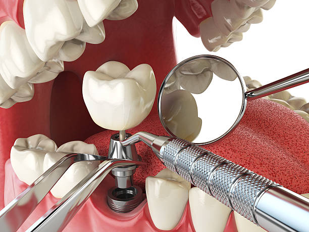 Best Emergency Wisdom Teeth Removal in Florence, MT